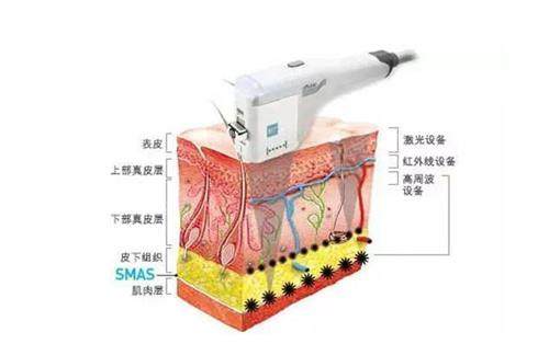 激光祛红血丝示意图
