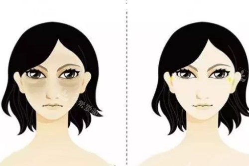 祛黑眼圈卡通对比图