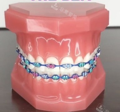 牙齿矫正牙套模型示意图