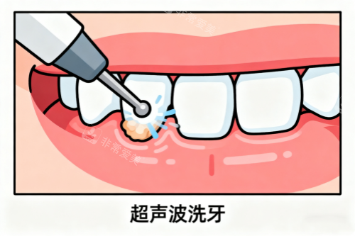 超声波洗牙卡通图