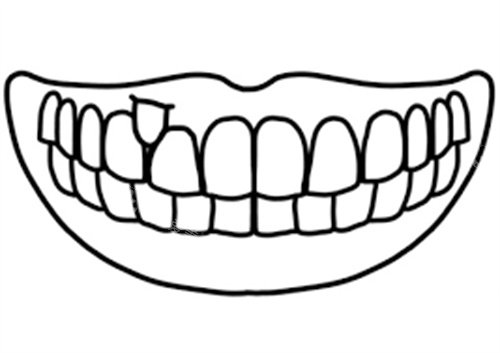 多生牙在外侧图