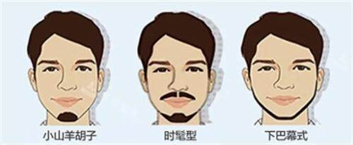 胡须种植的类型