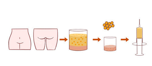 臉部脂肪填充圖