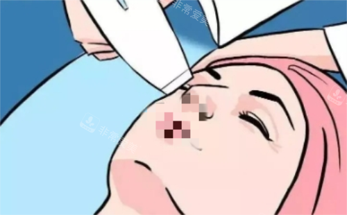 激光除皱示意图 激光除皱示意图