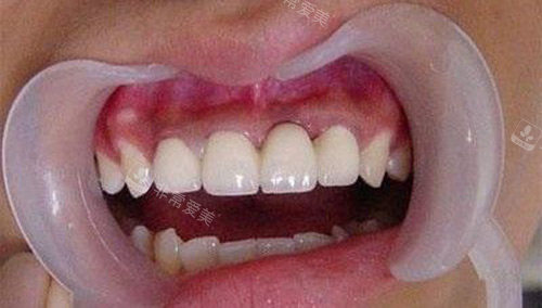 烤瓷牙后的牙齿情况