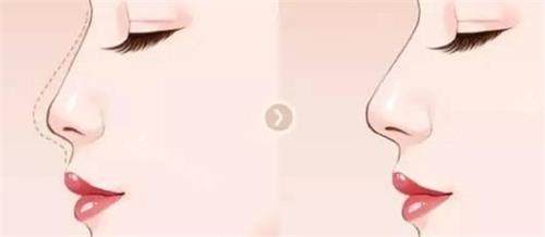 液态隆鼻后的成效
