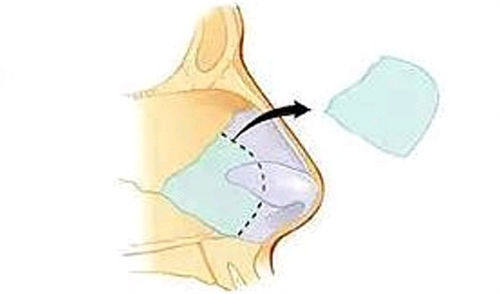 鼻中隔软骨隆鼻移除位置展示图
