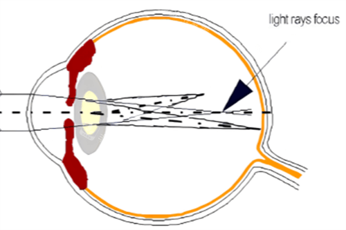 屈光不正散光示意图