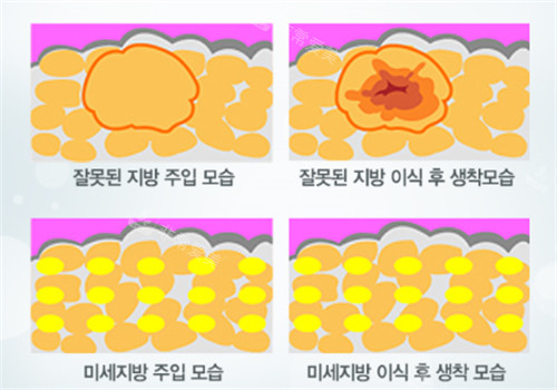 自体脂肪填充术后脂肪细胞前后对比 自体脂肪填充术后脂肪细胞前后对比