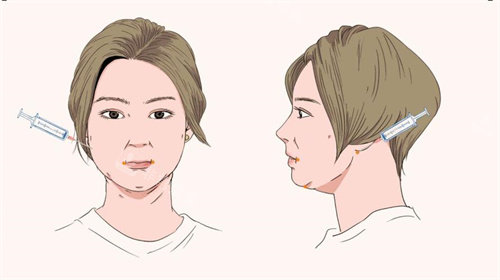 面部吸脂手术针管注射点位动画图 面部吸脂手术针管注射点位动画图