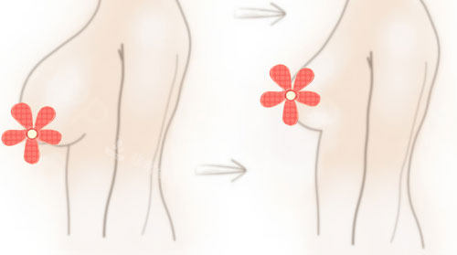 丰胸乳房缩小手术对比漫画图