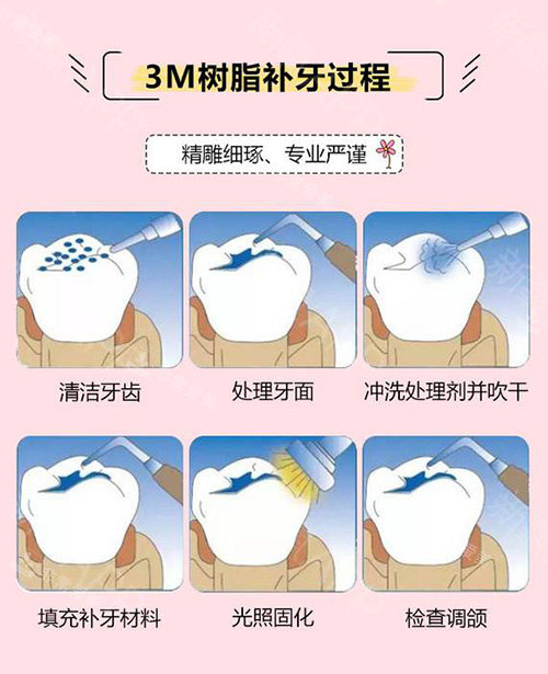 3M树脂补牙过程