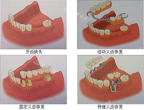 牙齿缺失修复多种方式