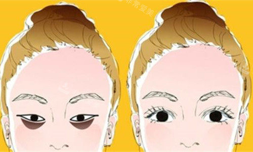 眼袋明显对比图 眼袋明显对比图