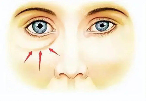 眼袋位置卡通示意图 眼袋位置卡通示意图