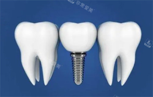 种植体与真实牙齿对比漫画图
