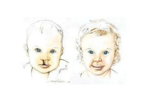 唇腭裂修复对比图