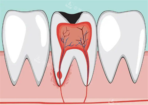 牙髓炎卡通示意图