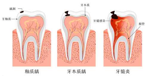 牙髓炎发展过程