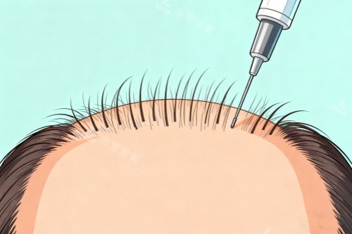 发际线种植卡通图 发际线种植卡通图