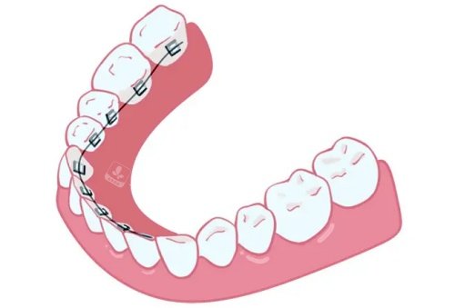 舌侧牙套示意图