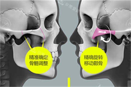 北京圣嘉新医疗美容医院张笑天颧骨颧弓整形示意图