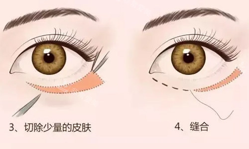 外切祛眼袋展示图 外切祛眼袋展示图