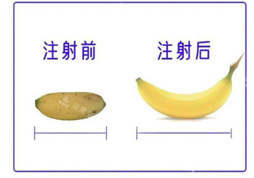 丁丁打玻尿酸前后对比 丁丁打玻尿酸前后对比