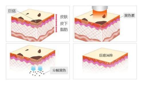 激光去痣过程 激光去痣过程