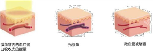 595染料激光治疗过程图解 595染料激光治疗过程图解