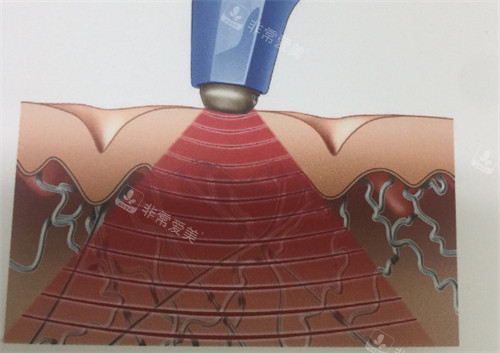 膨胀纹激光治疗过程 膨胀纹激光治疗过程