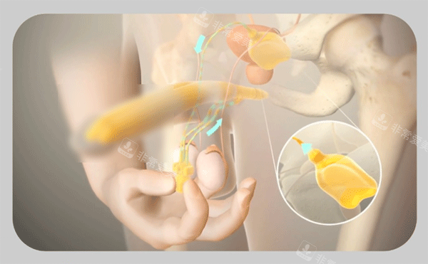 男性阴茎假体植入三件套手术过程