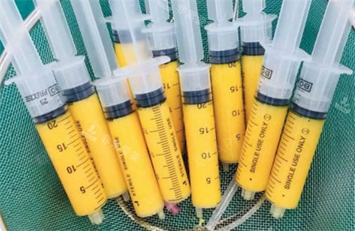 自体脂肪吸出后的样子 自体脂肪吸出后的样子