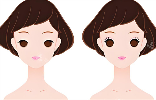 双眼皮前后对比图 双眼皮前后对比图