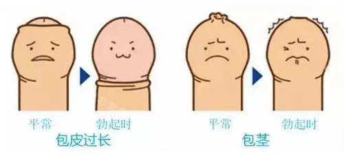 包皮过长和包茎