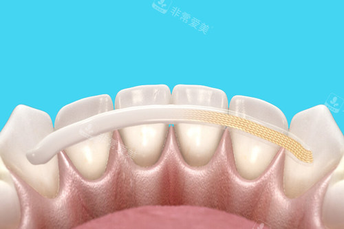 牙齿固定卡通图