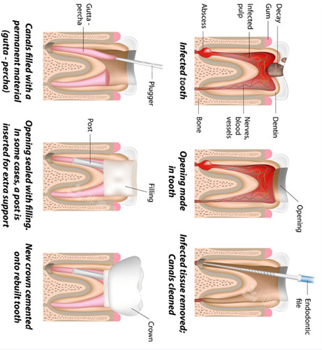根管治疗过程图