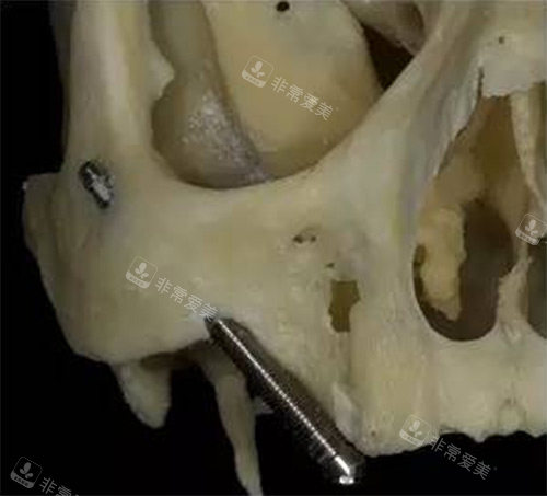 穿颧穿翼种植过程