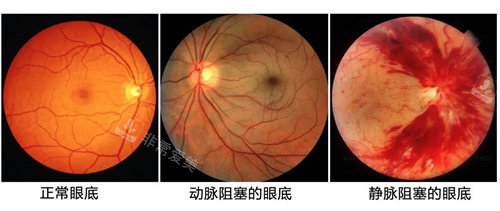 眼底检查的重要性