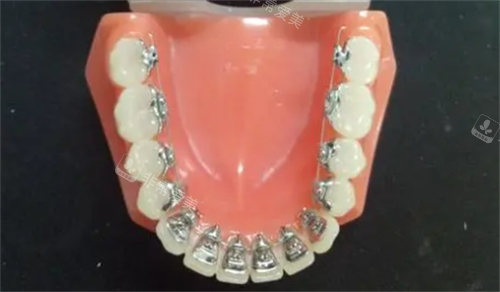 舌侧矫正模型展示