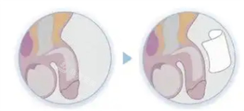 阴茎生物补片手术过程介绍