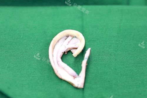 耳部再造 耳部再造