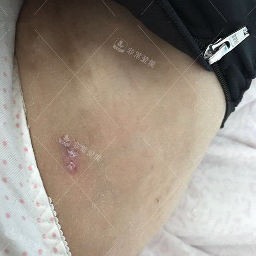 大腿吸脂伤口