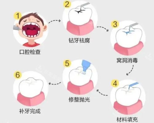 补牙具体步骤图