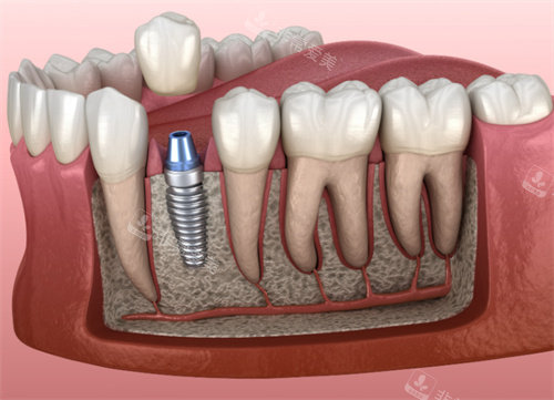 种植牙解剖模型