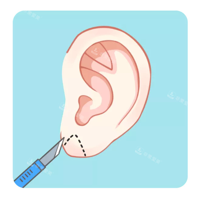 招风耳矫正术