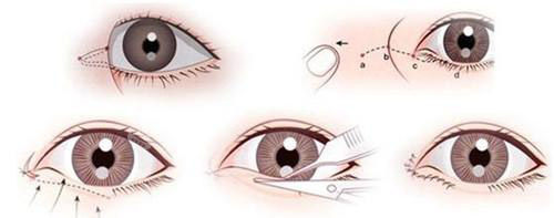 开眼角手术方法 开眼角手术方法