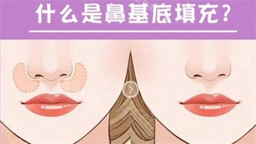 什么是鼻基底填充