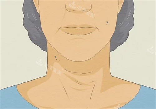 显老的颈纹 显老的颈纹