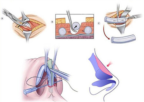 韩国ID整形医院李基振怎么样？复杂鼻型重建医师，矮塌鼻拯救者，收费公道无隐形消费